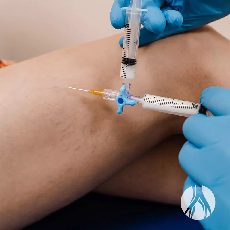 Escleroterapia com Espuma